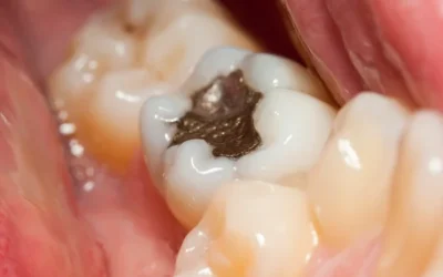 Silver Amalgam Fillings